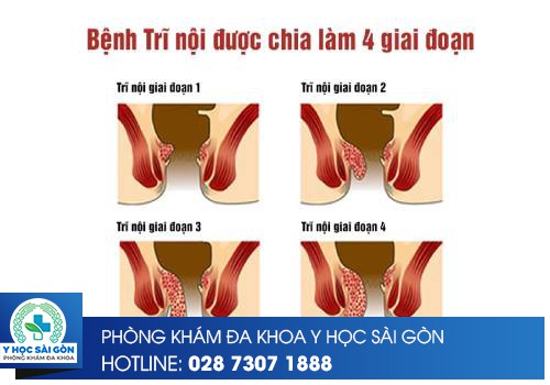 Trĩ nội qua các giai đoạn