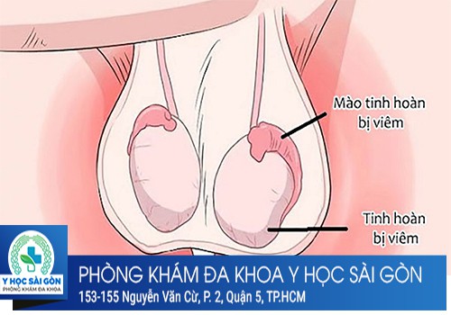 Tìm hiểu nguyên nhân và cách điều trị viêm tinh hoàn