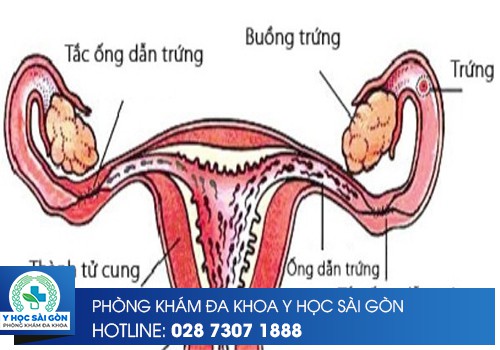 Hình ảnh tắc ống dẫn trứng