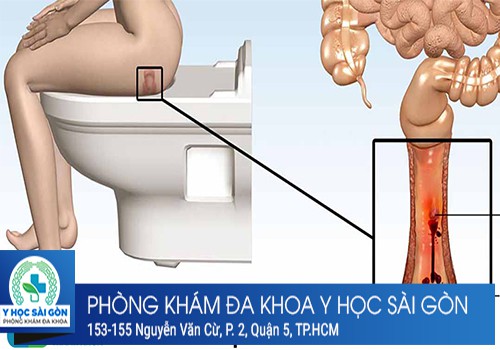 sưng hậu môn do bệnh trĩ