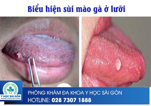 biểu hiện sùi mào gà ở lưỡi