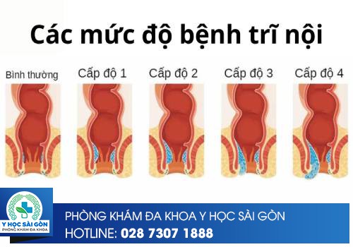 các mức độ bệnh trĩ