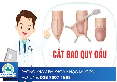 cắt bao quy đầu