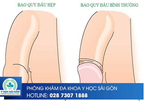 bao quy đầu hẹp và bao quy đầu bình thường