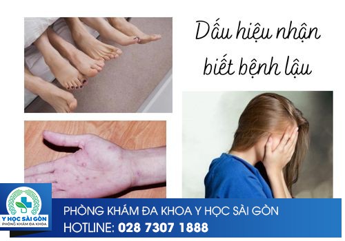 Những dấu hiệu nhận biết sớm bệnh lậu