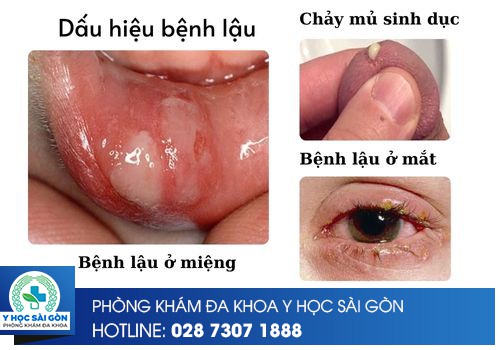 dấu hiệu nhận biết bệnh lậu