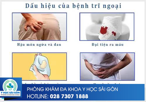 dấu hiệu bệnh trĩ ngoại