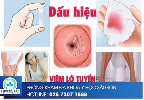 dấu hiệu viêm lộ tuyến