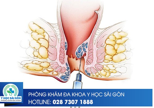 ⚕️ Trĩ Nội Có Bao Nhiêu Cách Điều Trị?