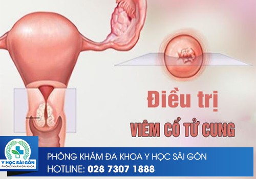 điều trị viêm cổ tử cung