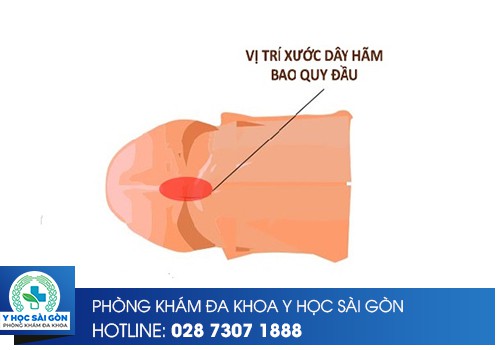 Giải Đáp Về Hiện Tượng Dây Hãm Bao Quy Đầu Bị Xước