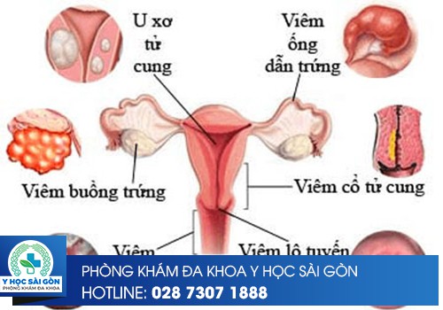 Nguyên Nhân Viêm Ống Dẫn Trứng