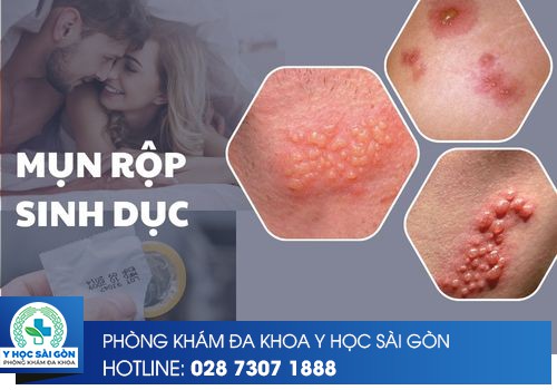 mụn rộp sinh dục