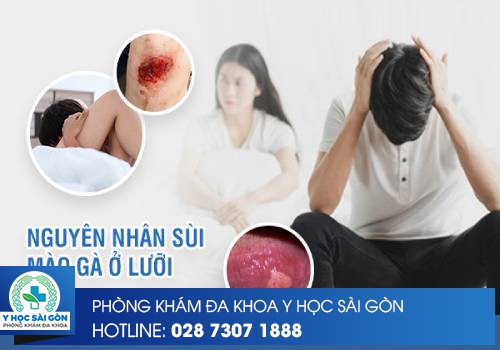 nguyên nhân sùi mào gà ở lưỡi