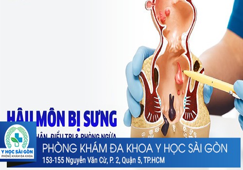 nguyên nhân dẫn đến sưng hậu môn