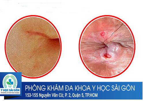 nứt kẽ hậu môn