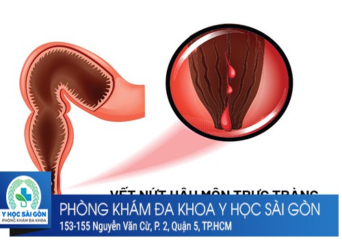 Nứt kẽ hậu môn