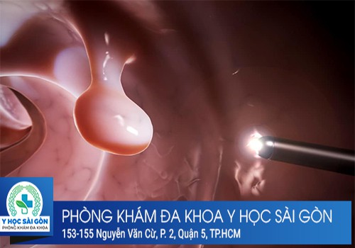 polyp hậu môn