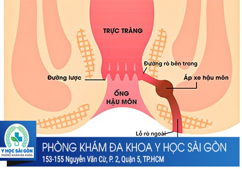 Rò hậu môn