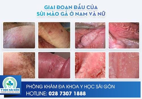 Hình ảnh sùi mào gà giai đoạn đầu