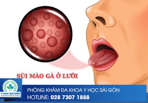 Sùi Mào Gà Ở Lưỡi: Dấu Hiệu, Hình Ảnh, Cách Chữa