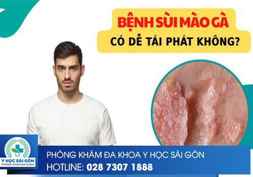 Bệnh Sùi Mào Gà Có Dễ Tái Phát Hay Không?