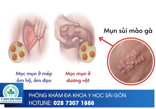 sùi mào gà ở nam và nữ