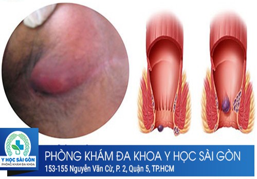 sưng hậu môn do viêm ông hậu môn