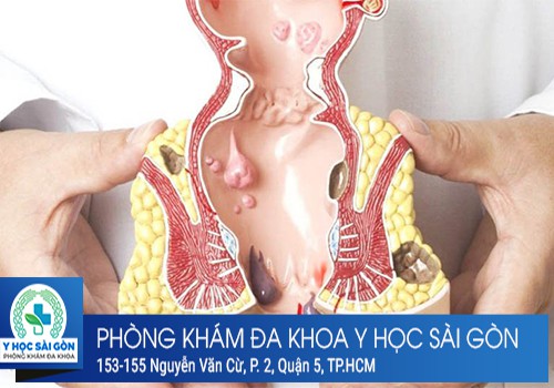 Sưng Hậu Môn Là Dấu Hiệu Của Bệnh Gì? Nguy Hiểm Không?