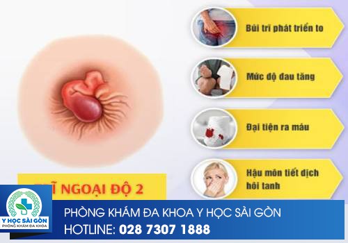 dấu hiệu trĩ ngoại độ 2