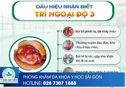 dấu hiệu nhận biết trĩ ngoại độ 3