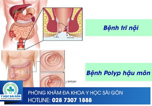 Phân Biệt Trĩ Nội Và Polyp Hậu Môn