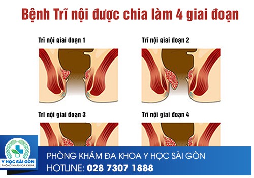 ⚕️ Trĩ Nội Có Bao Nhiêu Cấp Độ?