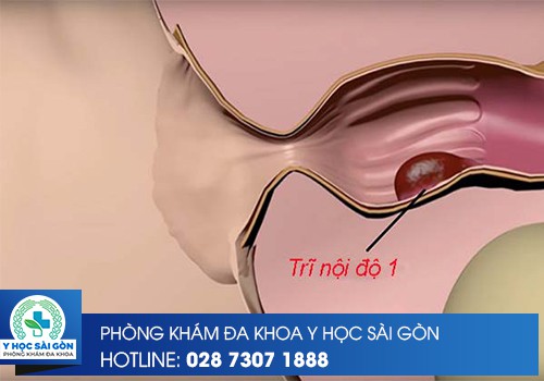 ⚕️ Trĩ Nội Độ 1 Có Nguy Hiểm Không?