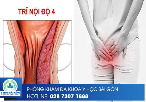 ⚕️ Trĩ Nội Độ 4 Có Điều Trị Được Không?