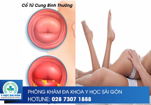 viêm cổ tử cung có quan hệ tình dục được không