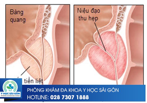  nhận biết bị viêm tuyến tiền liệt