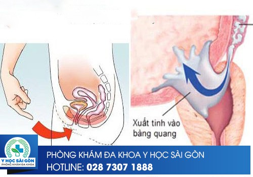 tinh dịch chảy ngược vào bàng quang